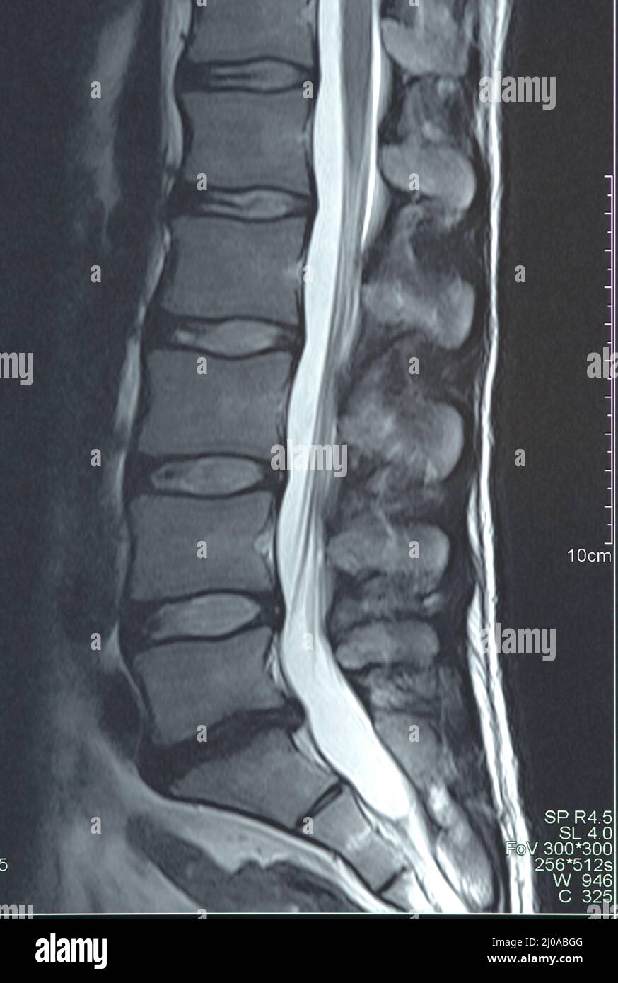 Magnetic resonance image of the lumbar spine Stock Photo - Alamy