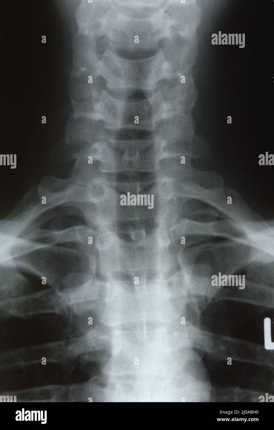 Cervical spine hi-res stock photography and images - Alamy