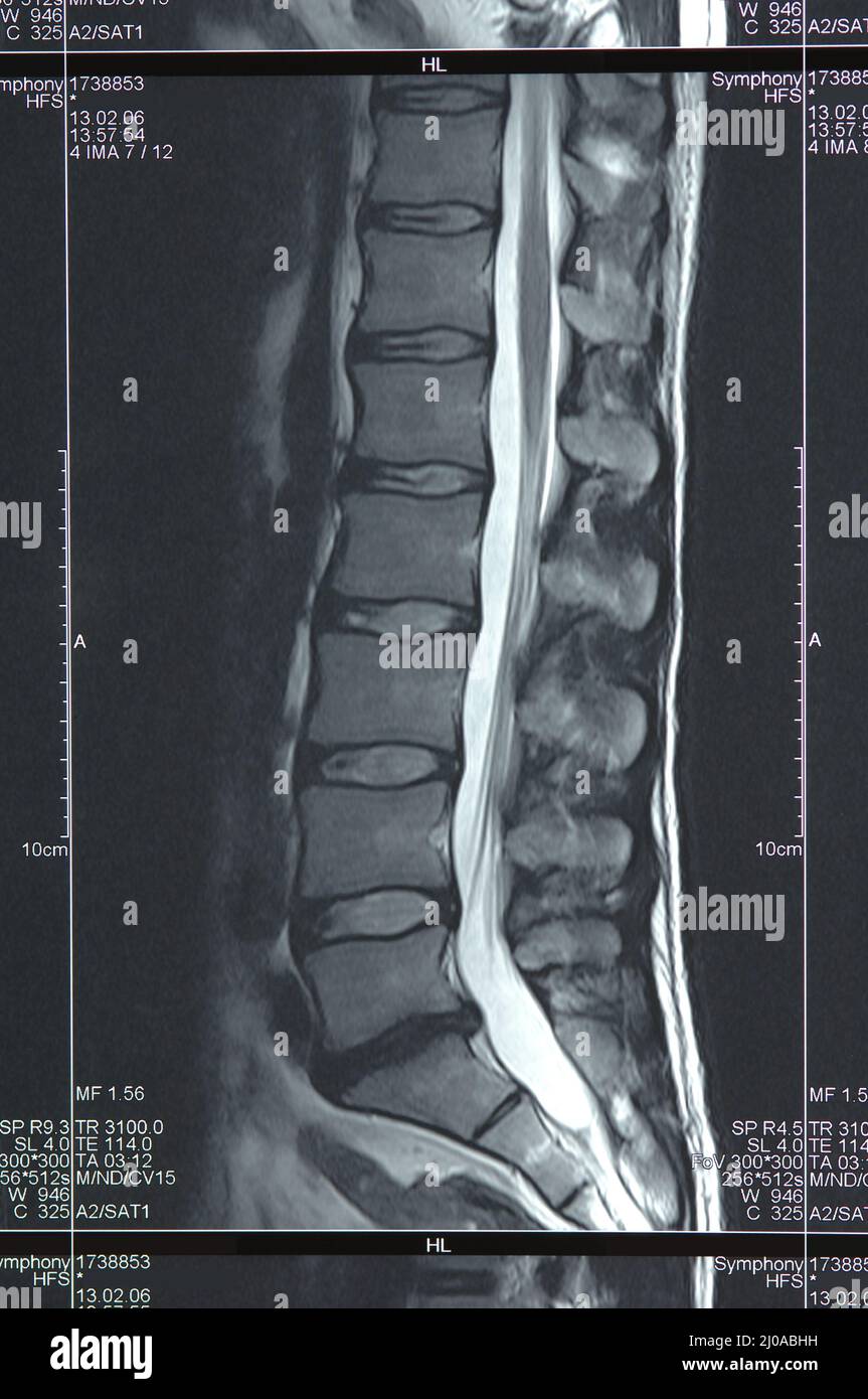 Magnetic resonance image of the lumbar spine Stock Photo - Alamy