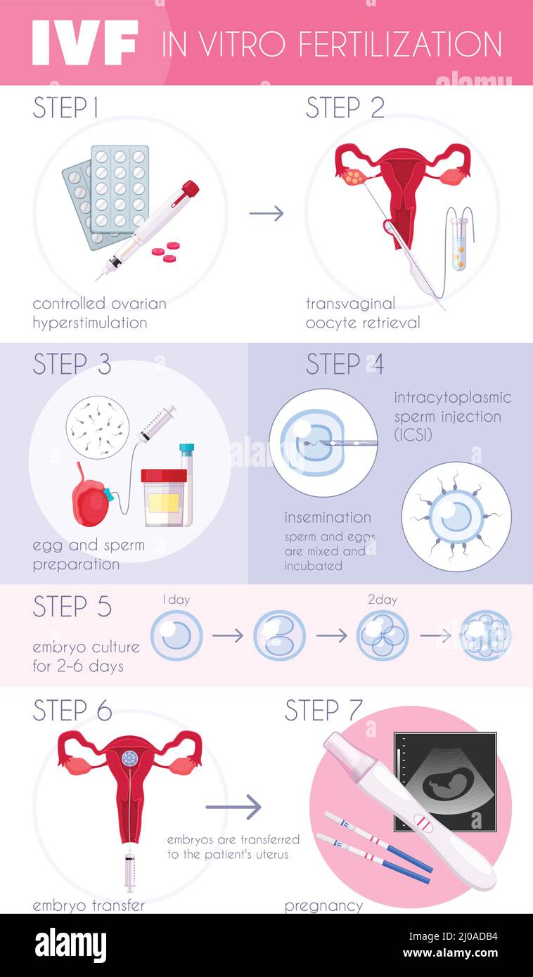 Colored flat in vitro fertilization IVF infographics with steps for ...