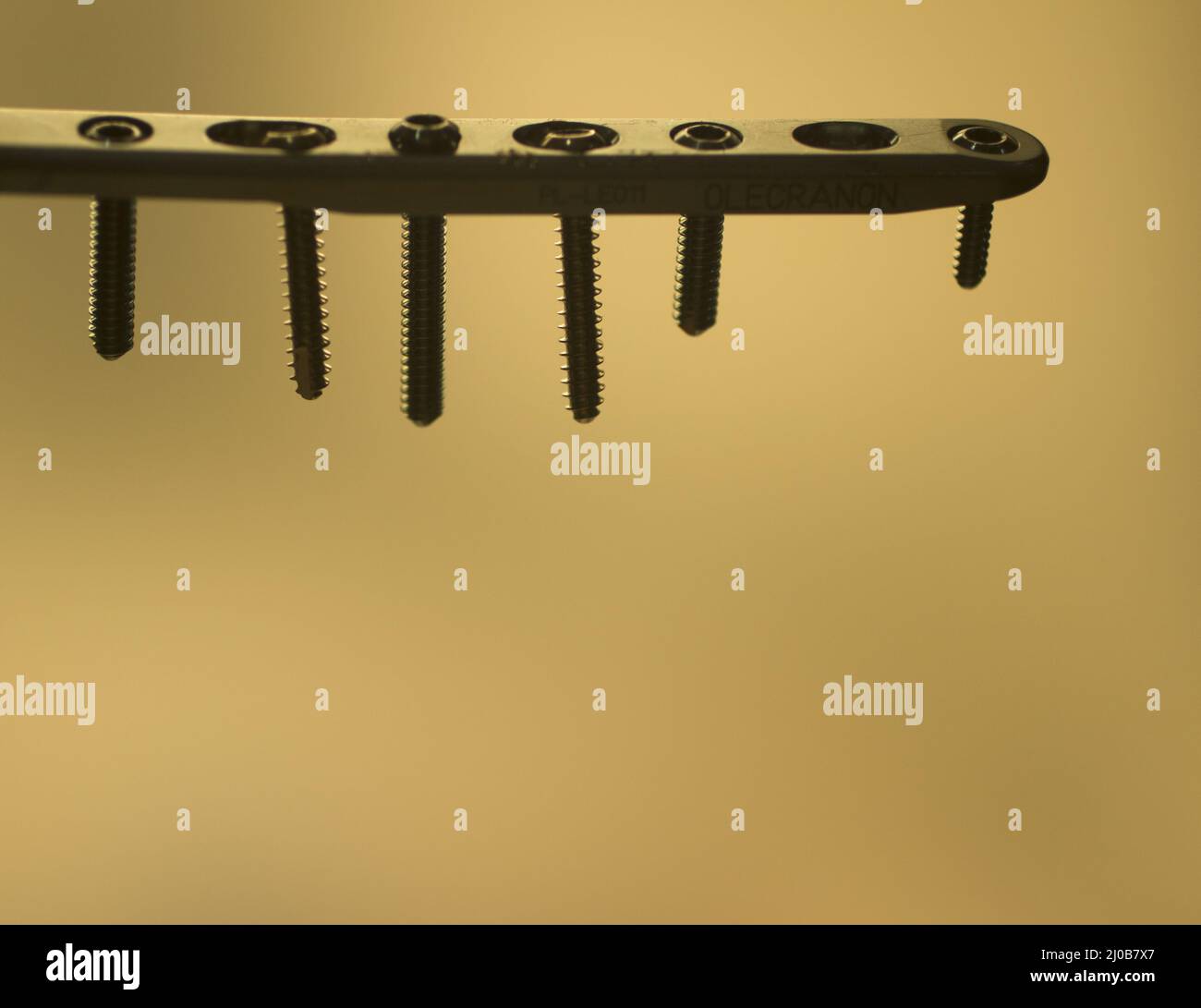 Traumatology orthopedic surgery implant plate and screws Stock Photo