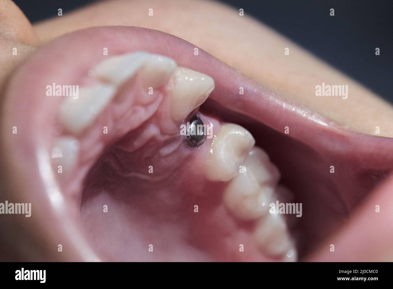 Real mouth with dental molar screw implant Stock Photo Alamy