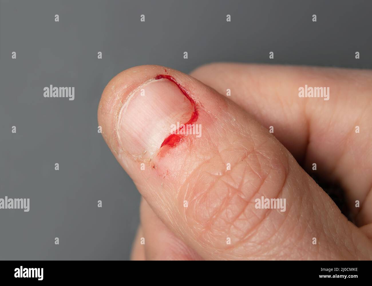 Bloody thumb from nail biting. Close up of adult female hand with fresh chewed fingernail and small wounds on the surrounding skin. Stock Photo