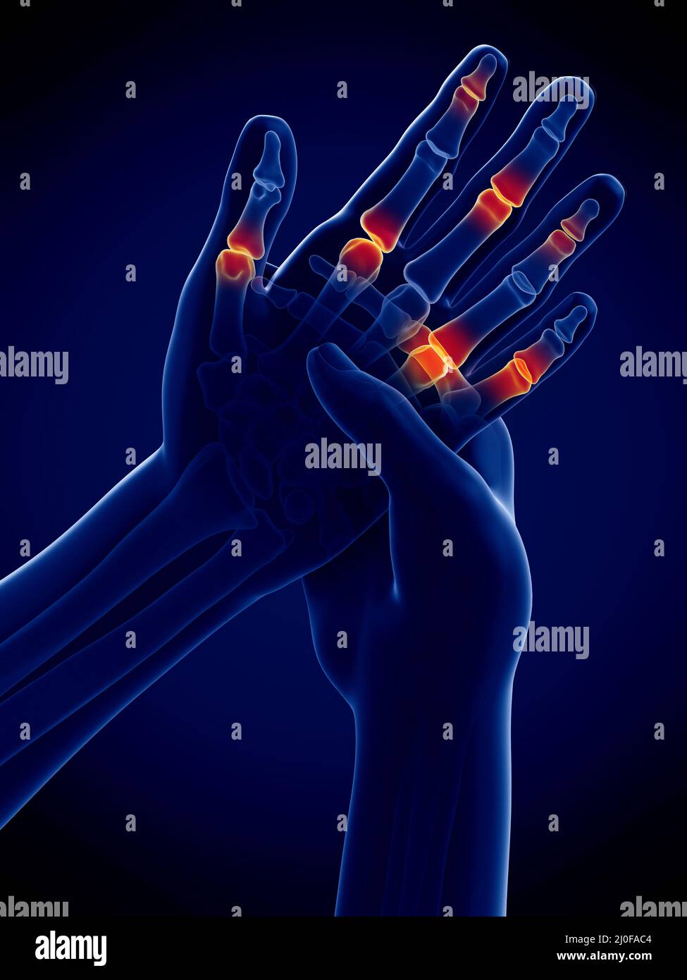 Painful finger joints, illustration Stock Photo Alamy