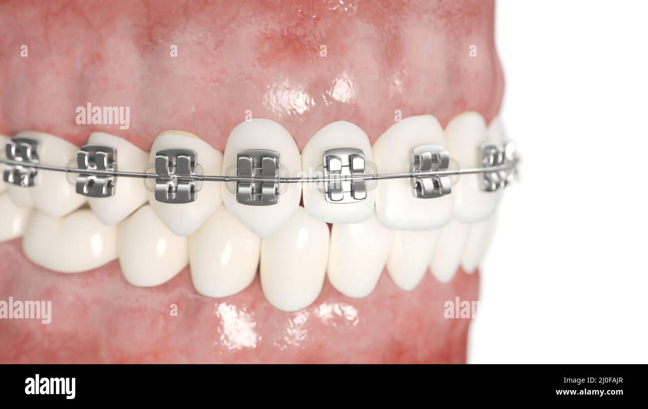 Dental braces, illustration Stock Photo Alamy