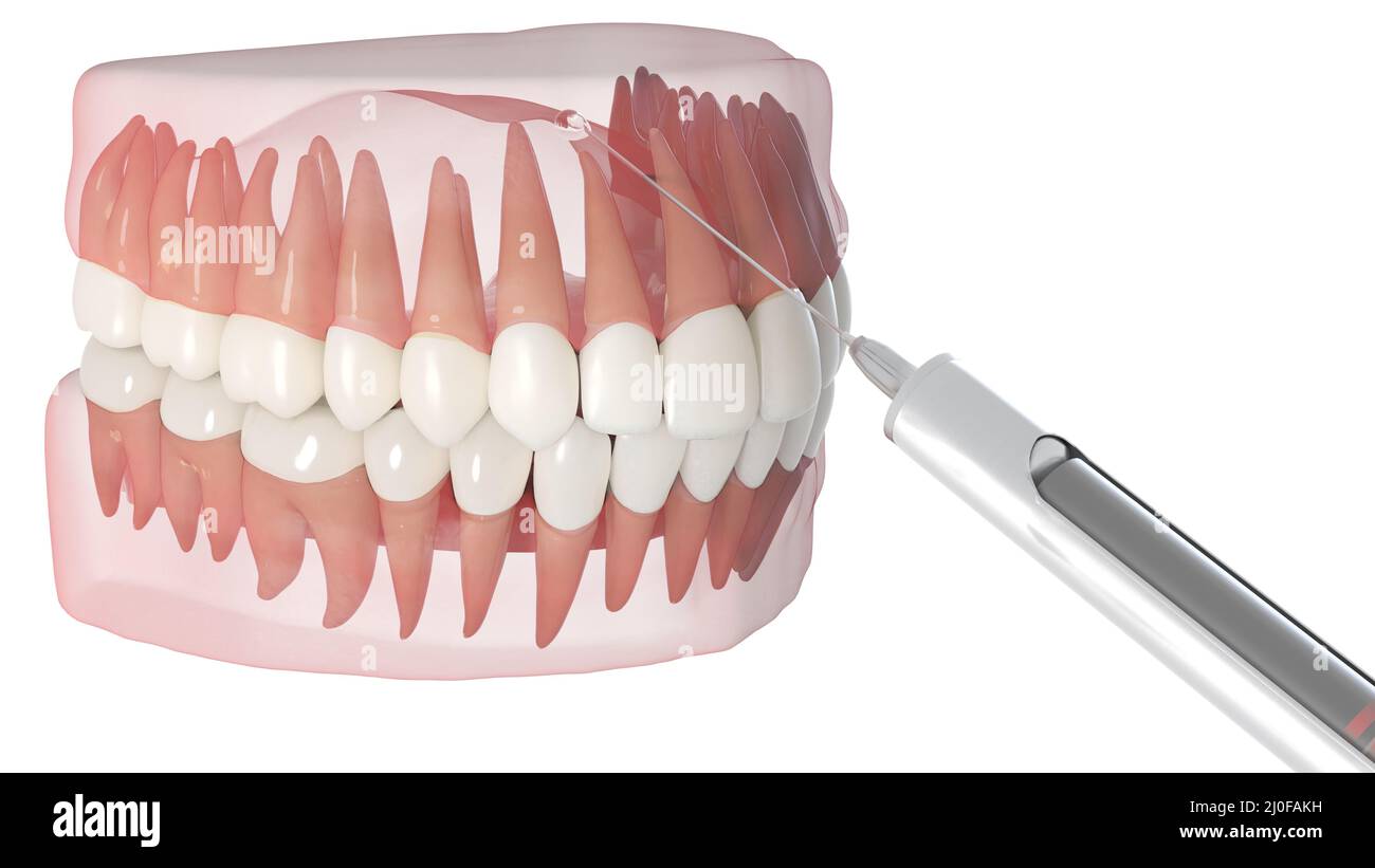 Dental anaesthesia, illustration Stock Photo Alamy