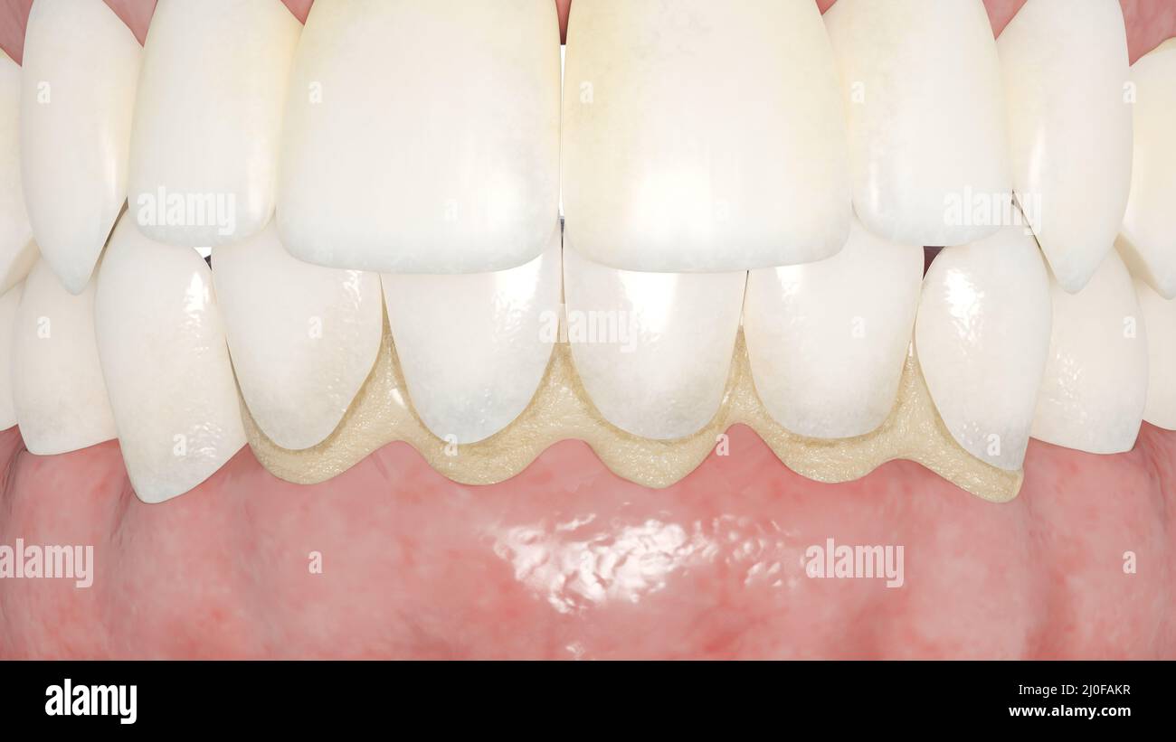 Dental calculus, illustration Stock Photo Alamy