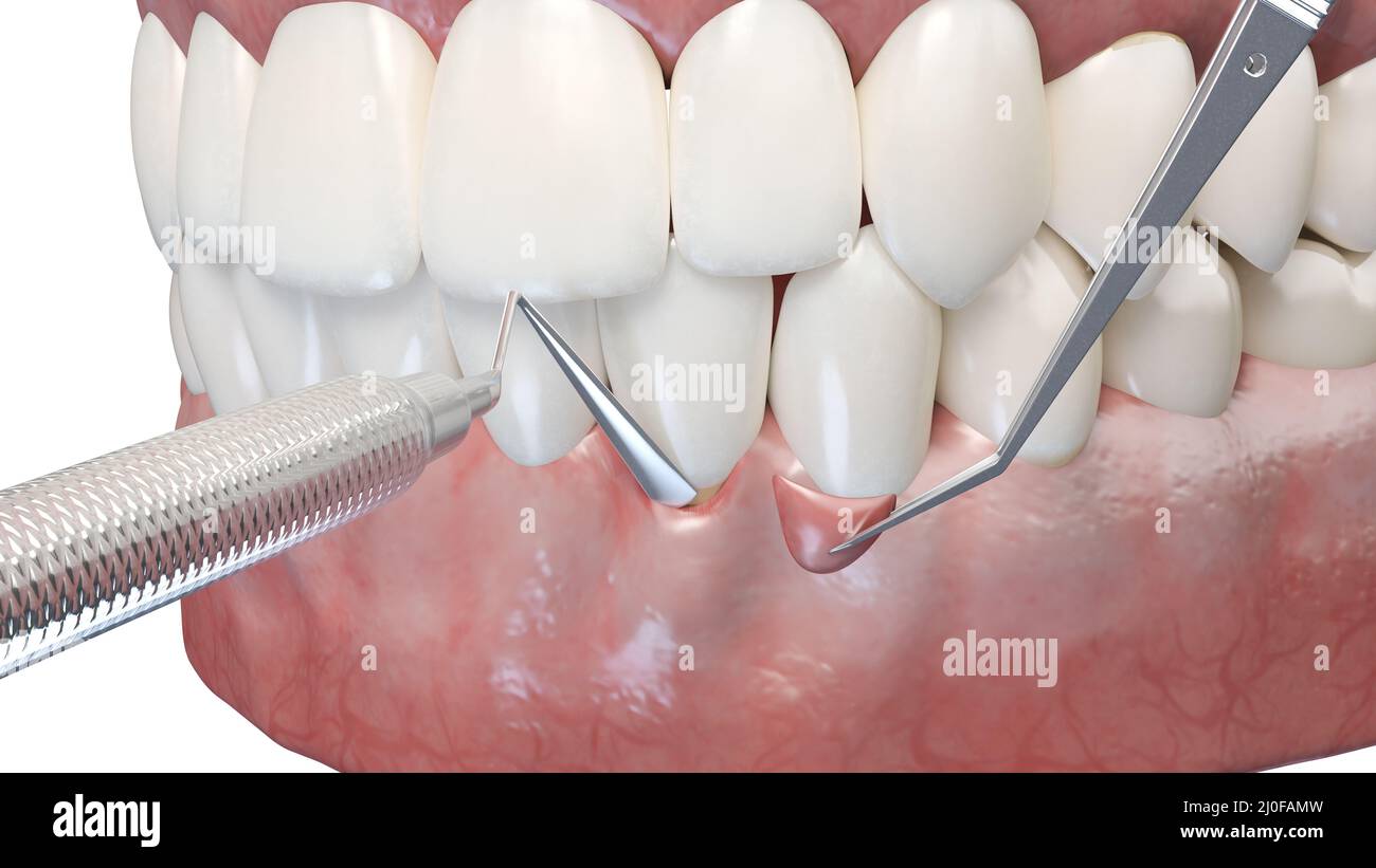 Gum graft surgery, illustration Stock Photo Alamy