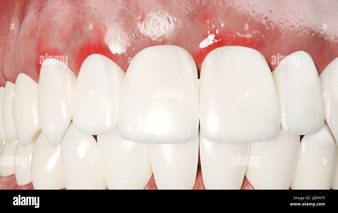 Periodontal disease, illustration Stock Photo - Alamy