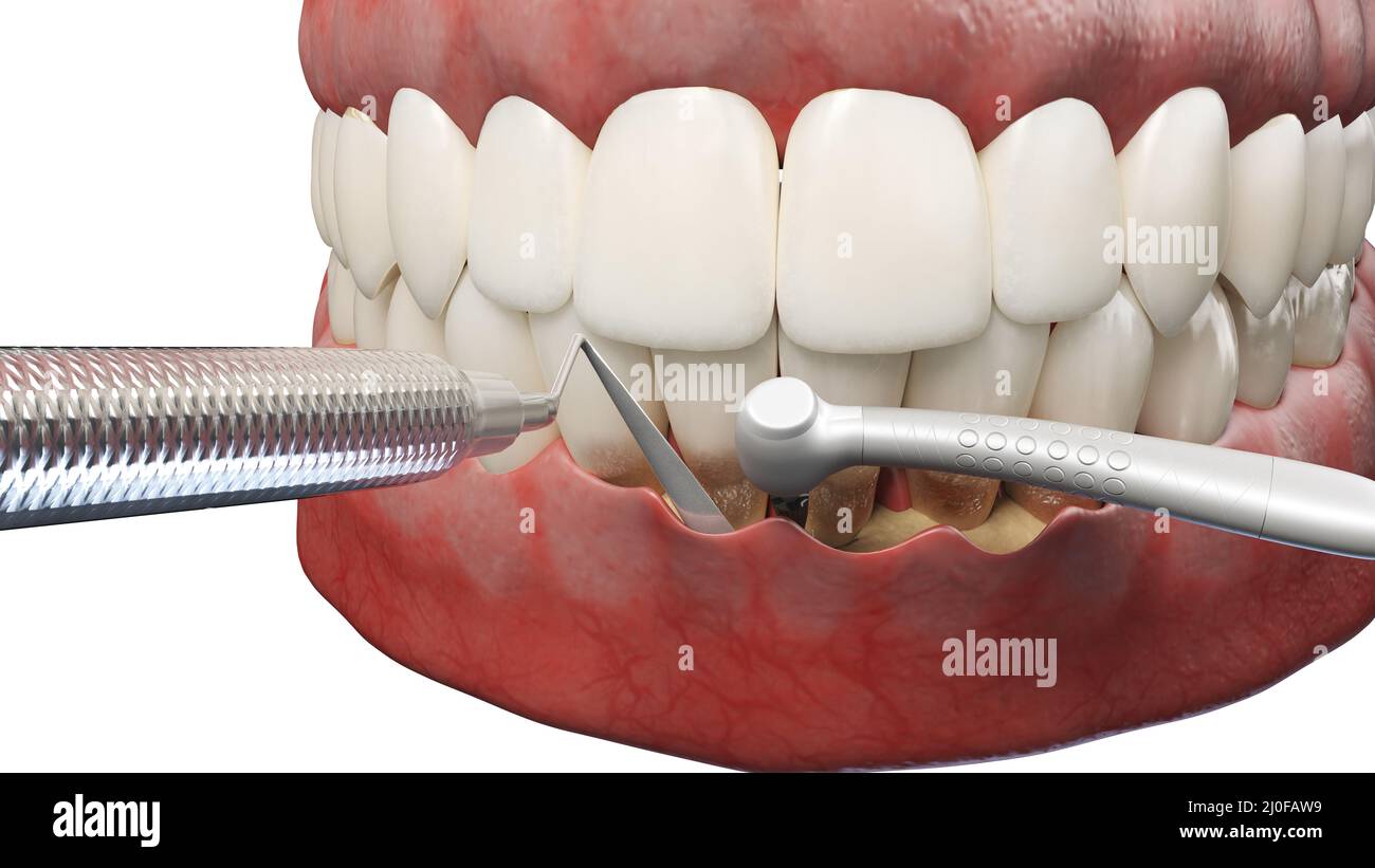 Dental pocket reduction, illustration Stock Photo Alamy
