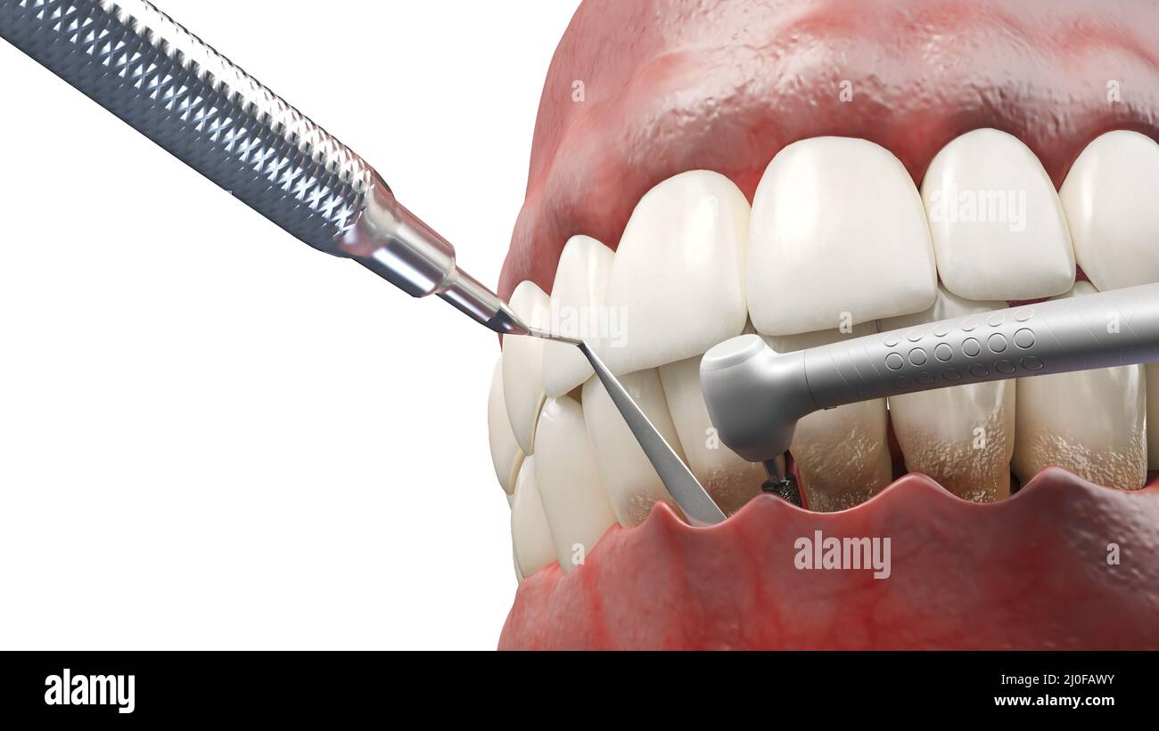 Dental pocket reduction, illustration Stock Photo Alamy