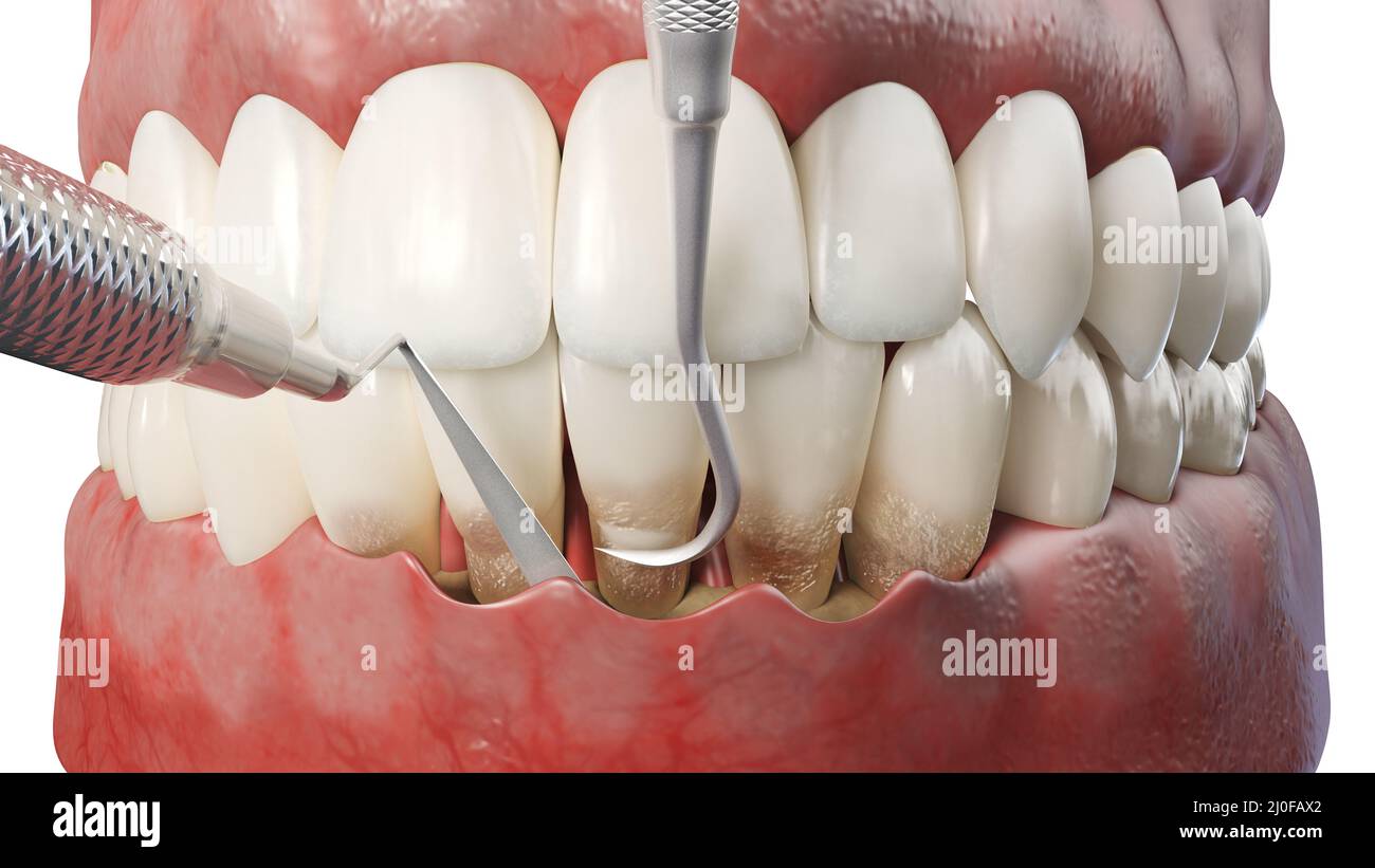 Dental root planing, illustration Stock Photo Alamy