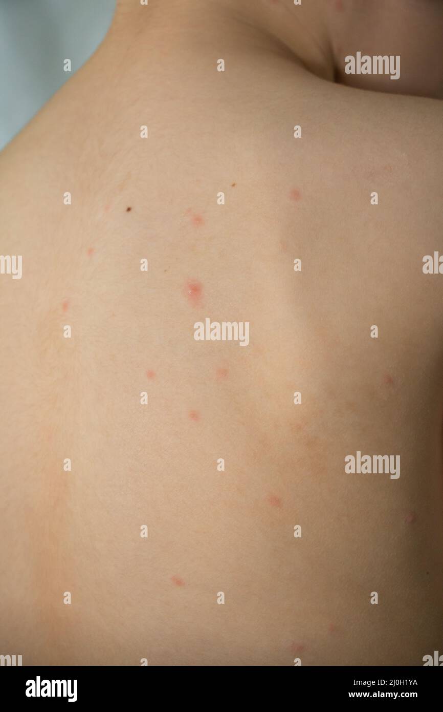 Back of child affected by chickenpox. Toddler with red itchy pimples