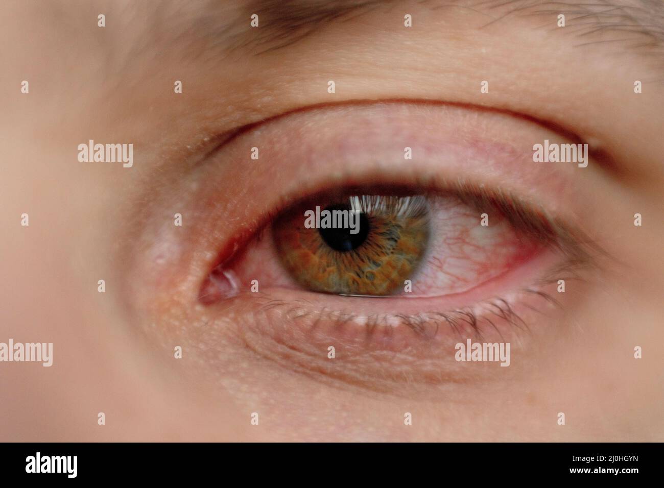 A man with a red, sore eye. An infection during illness struck the eyes
