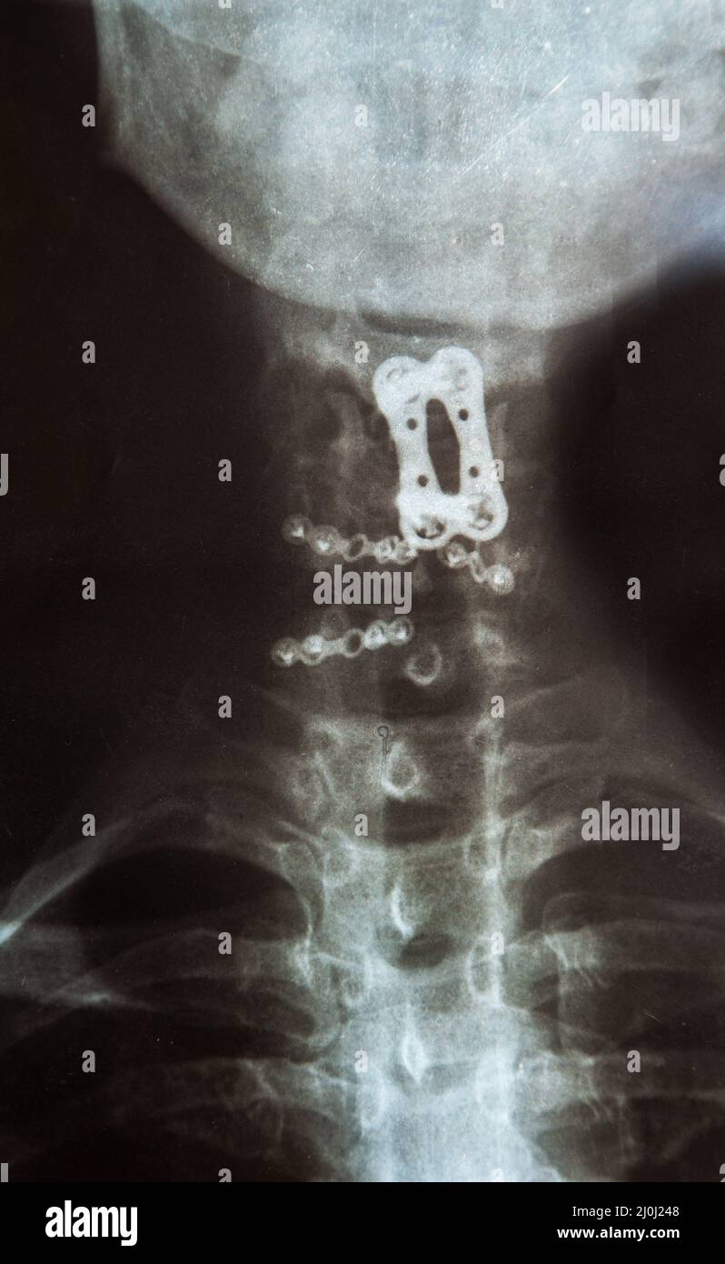 X-ray image of spinal column with implant, screw placement and fusion Stock Photo