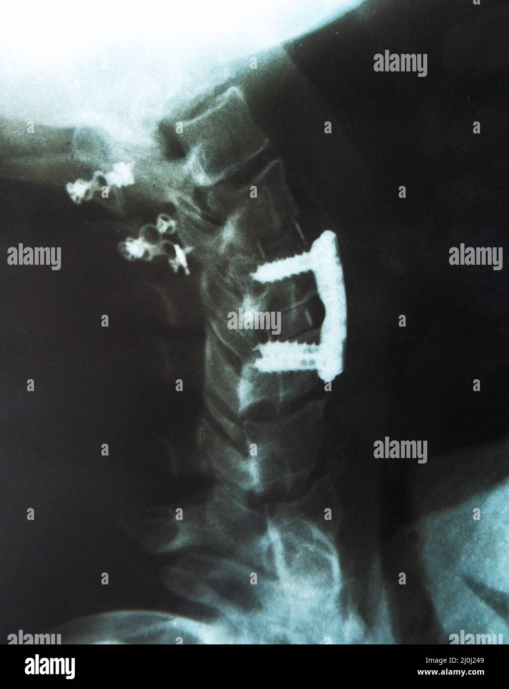 X-ray image of vertebral column with implant, screw placement and fusion Stock Photo
