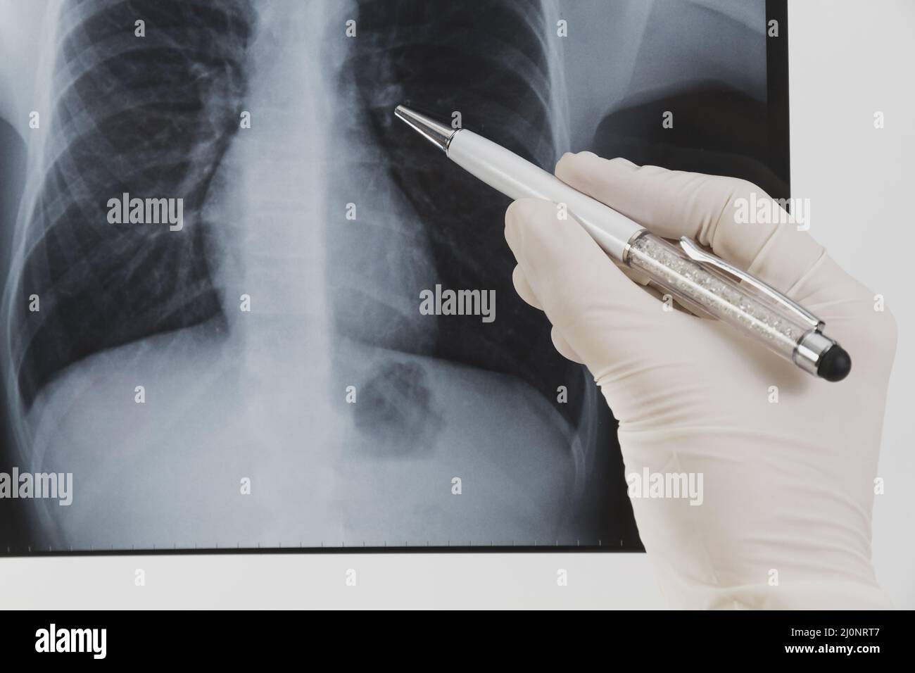 Radiography with pen. High quality and resolution beautiful photo concept Stock Photo