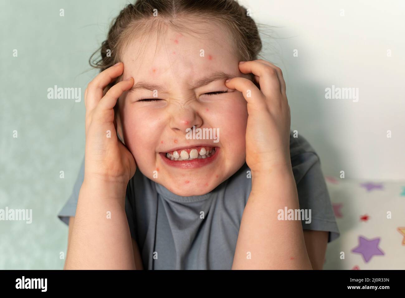 A seven-year-old little girl suffers from chickenpox at home. High quality photo Stock Photo