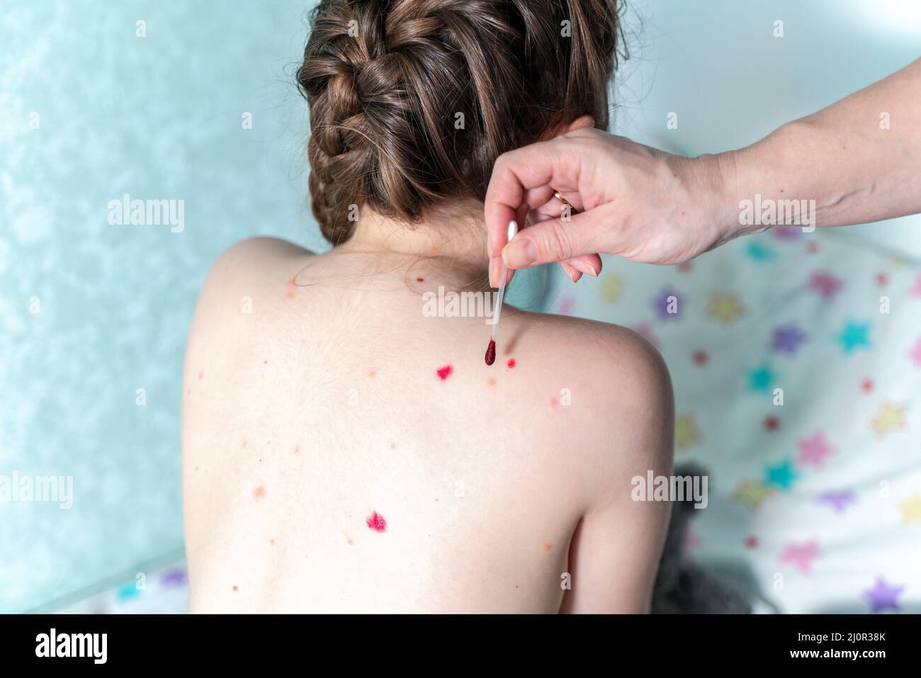 A seven-year-old little girl suffers from chickenpox at home. High quality photo Stock Photo
