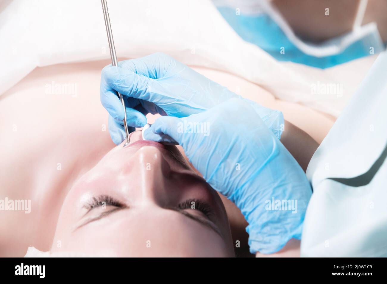 Close-up Mechanical face peel at the beautician. Beautician squeezes acne on the patient's forehead with a medical needle. Face Stock Photo