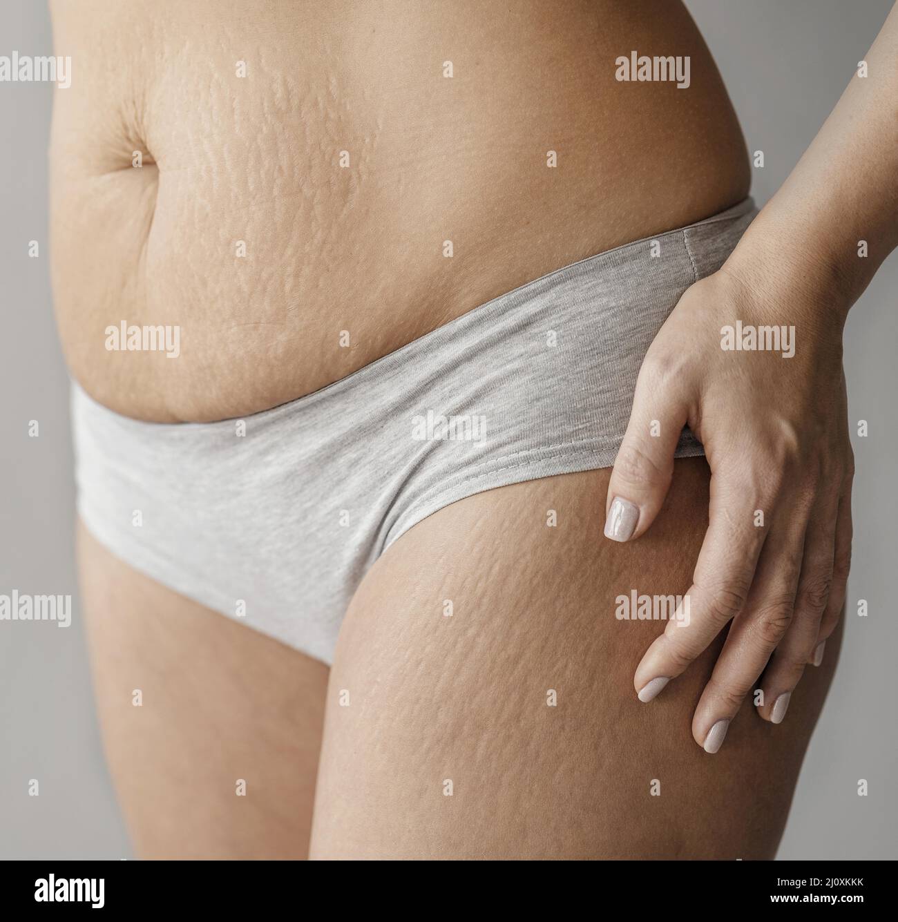Close up woman body with stretch marks. High quality beautiful photo concept Stock Photo