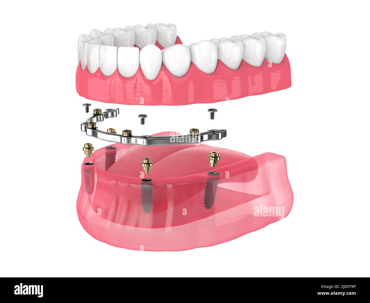 Bar retained removable overdenture installation supported by implants over white backgroud Stock