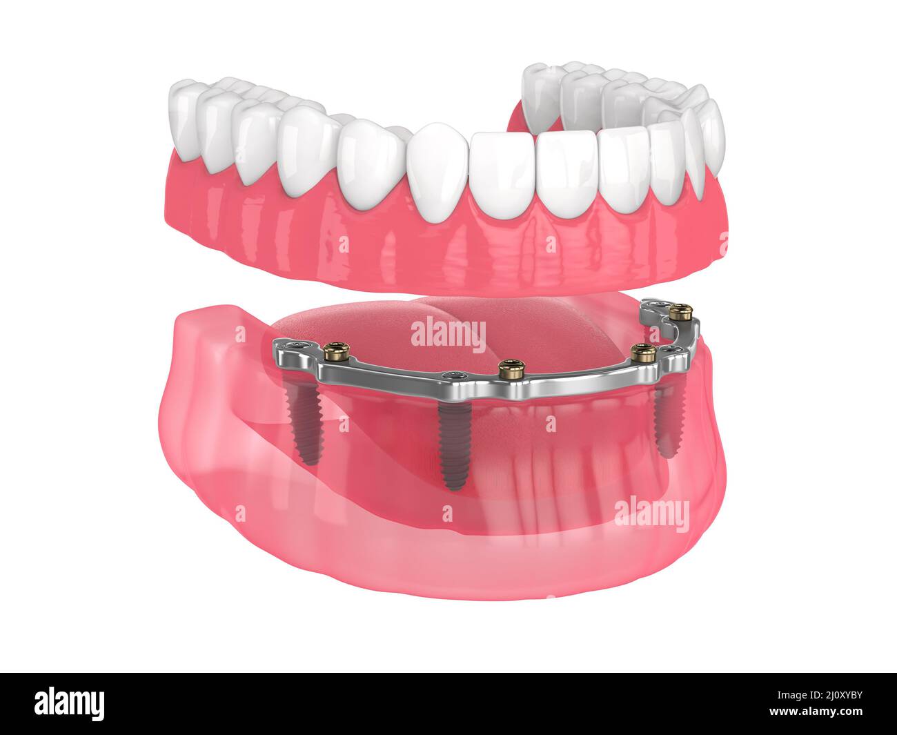 Bar retained removable overdenture installation supported by implants over white backgroud Stock Photo