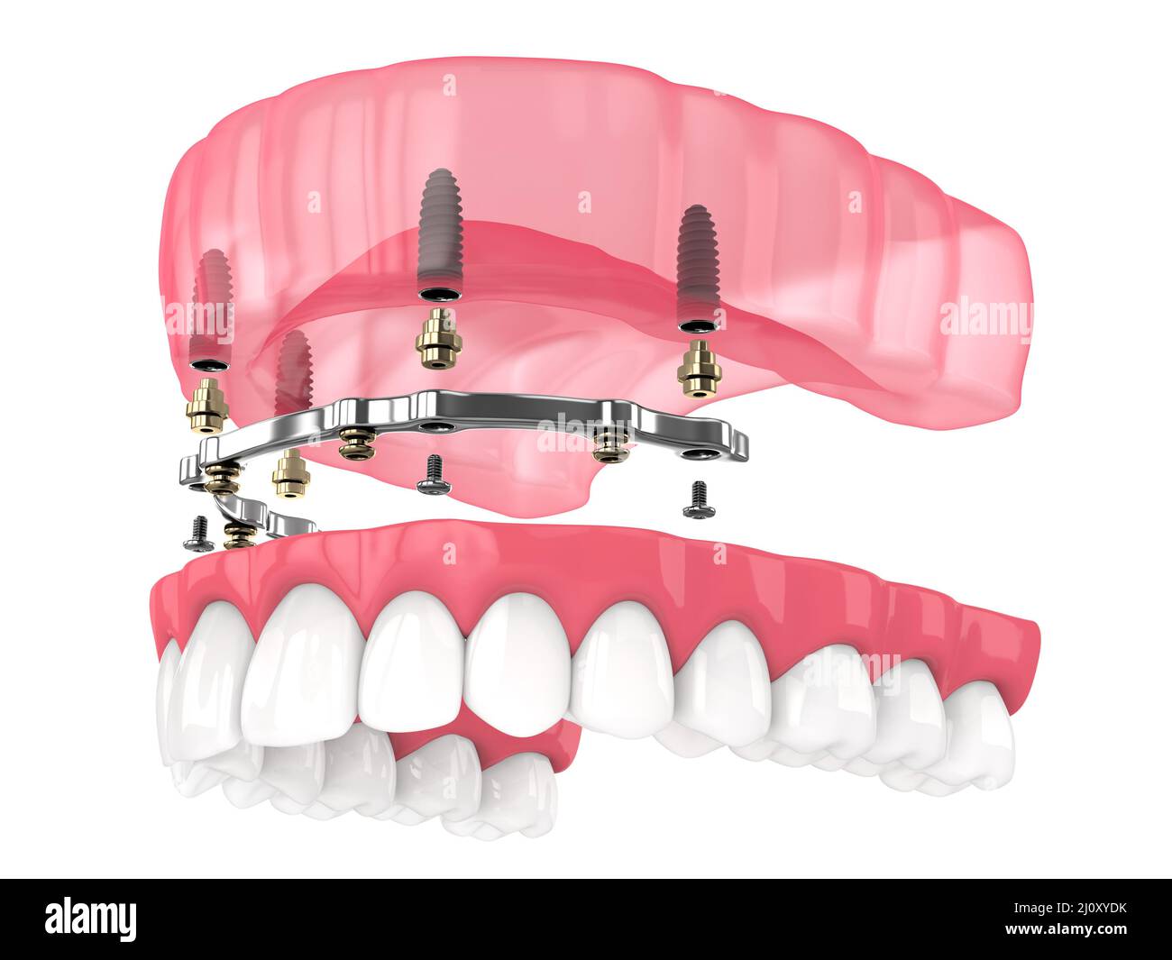 Bar retained removable overdenture installation supported by implants