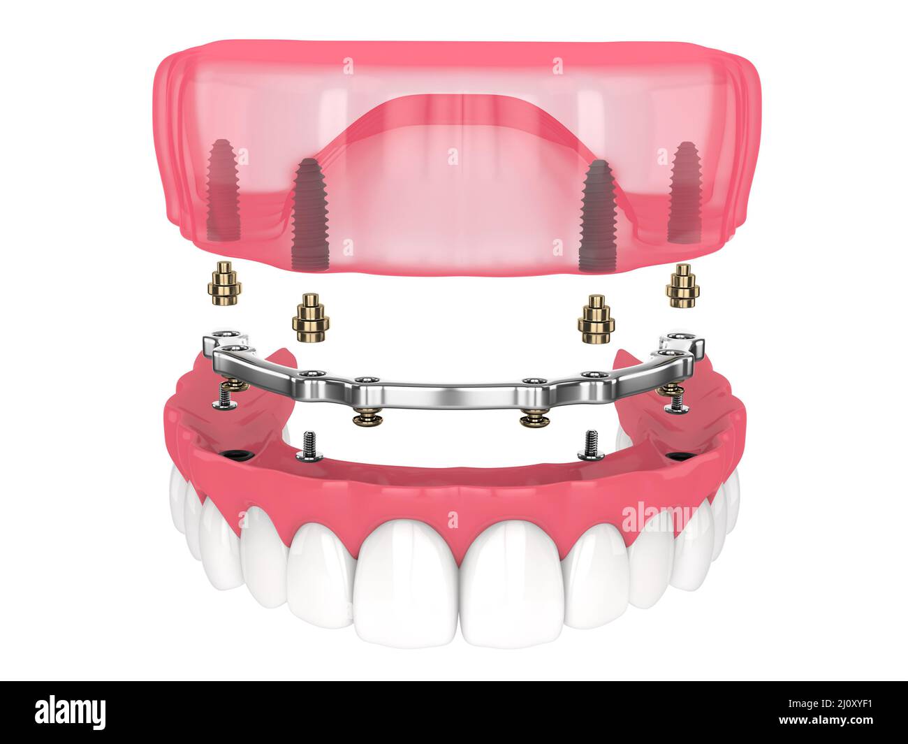 Bar retained removable overdenture installation supported by implants over white backgroud Stock