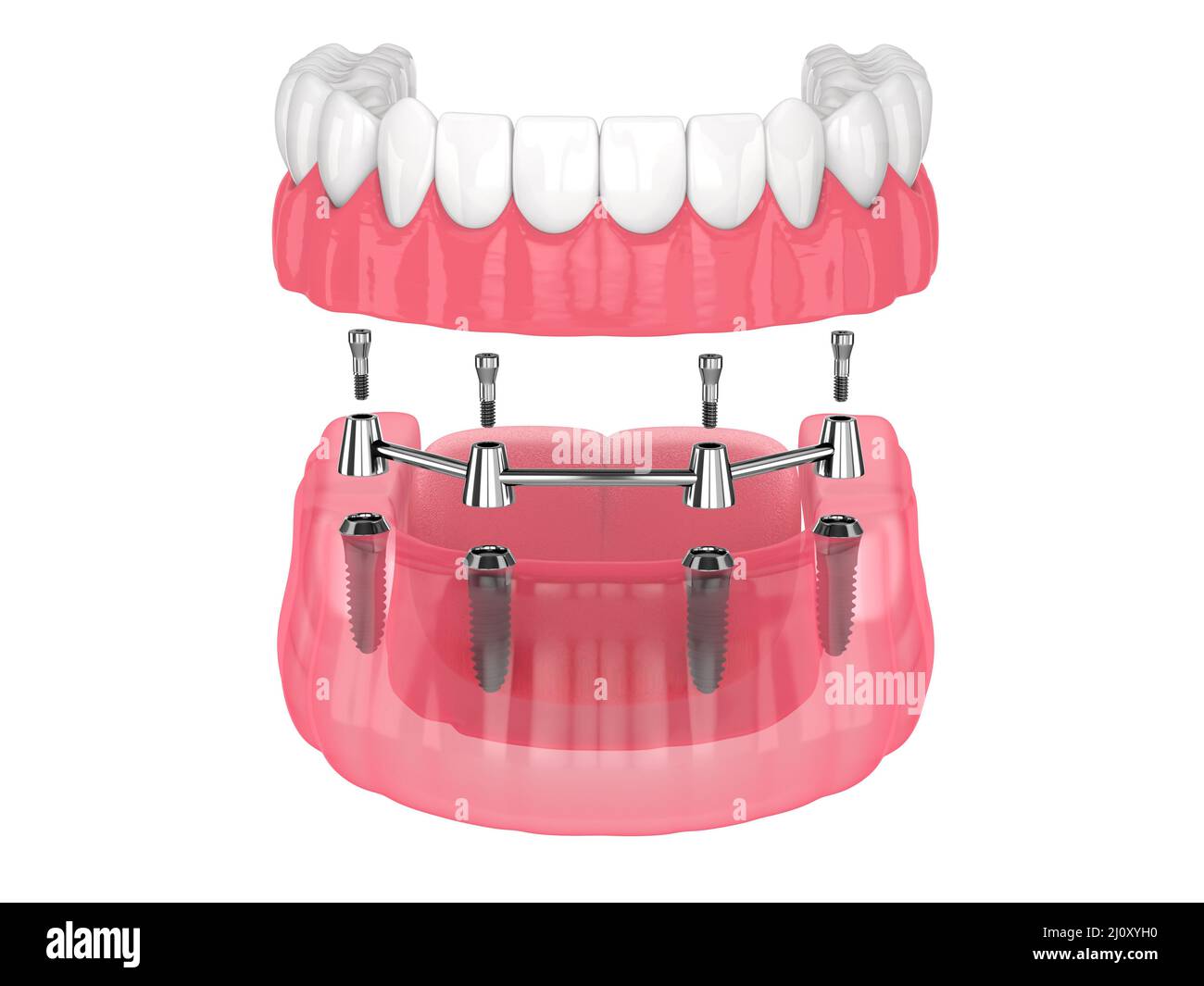 Removable overdenture installation on bar clip attachment, supported by