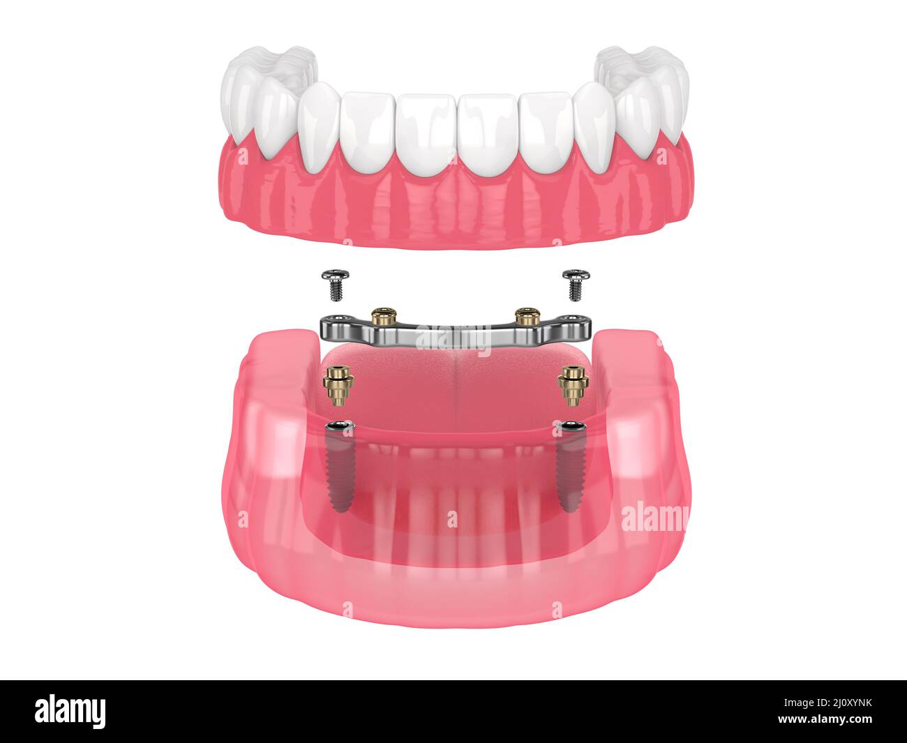 Bar retained removable overdenture installation supported by implants over white backgroud Stock