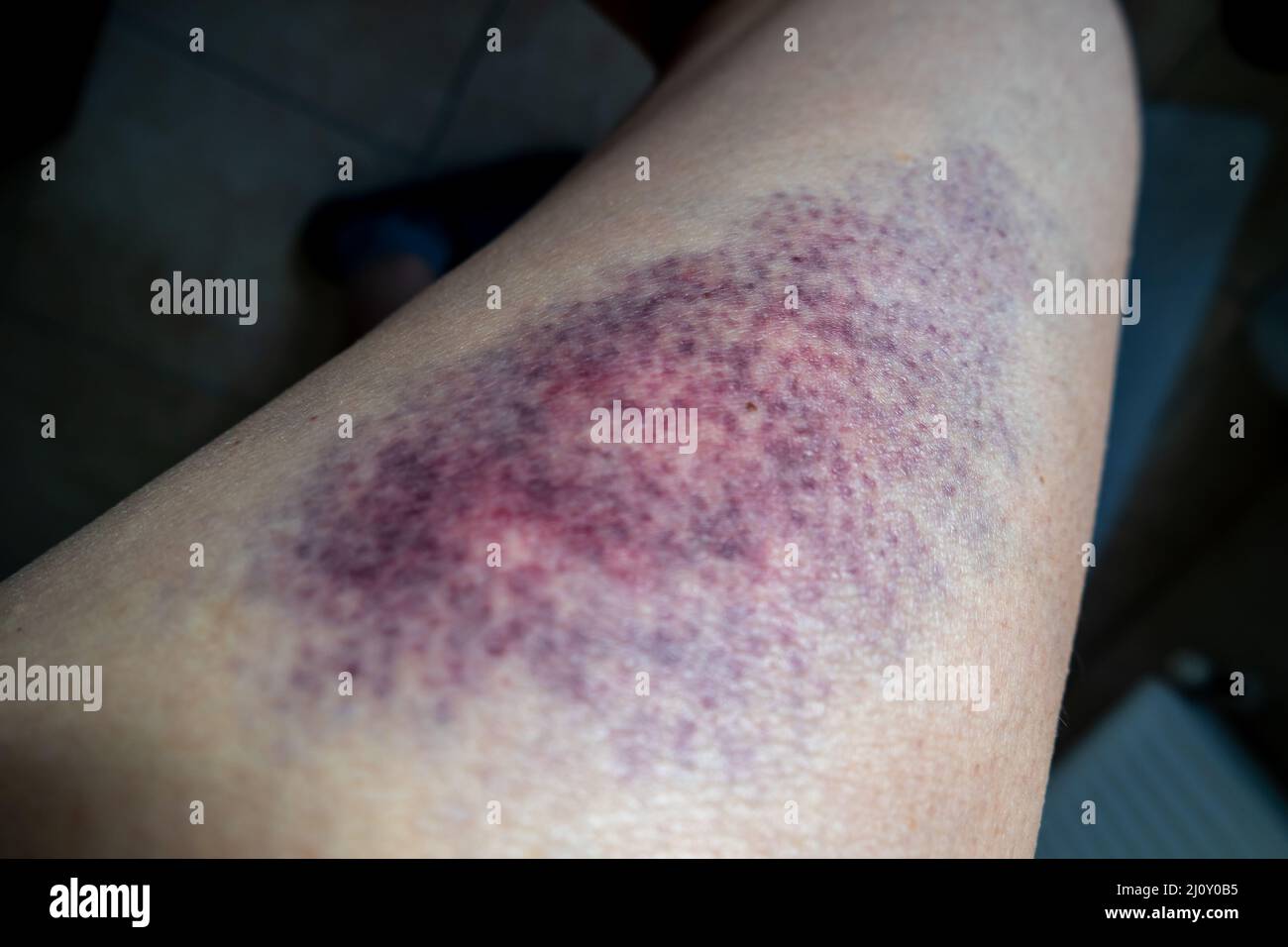 Terrible bruise on the upper leg of a woman. Stock Photo