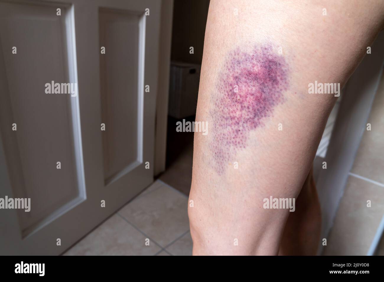 Terrible bruise on the upper leg of a woman. Stock Photo