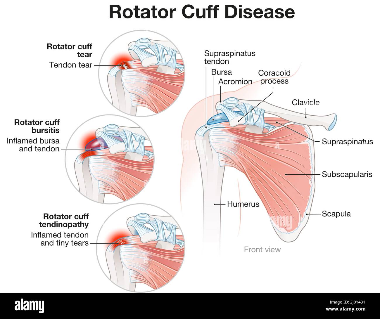 Illustration showing shoulder rotator cuff disease illustration Stock Photo Alamy