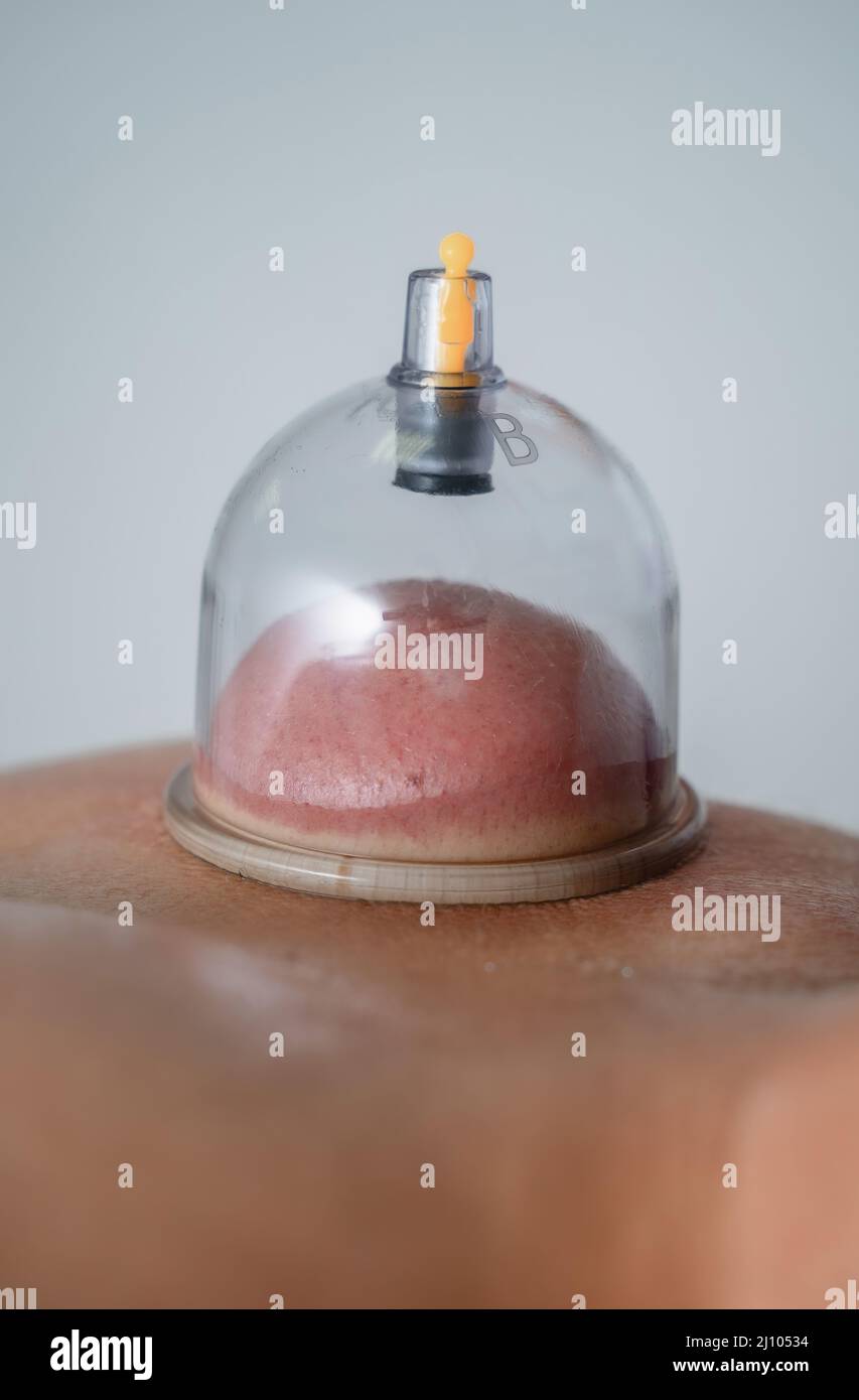 Massage cupping therapy Stock Photo Alamy