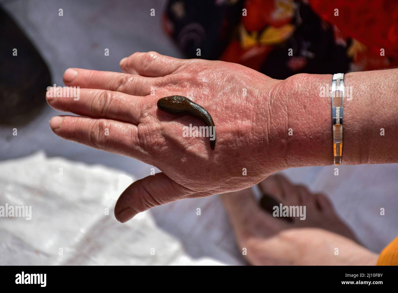 Srinagar, India. 21st Mar, 2022. A patient receives leech therapy. Every year traditional health