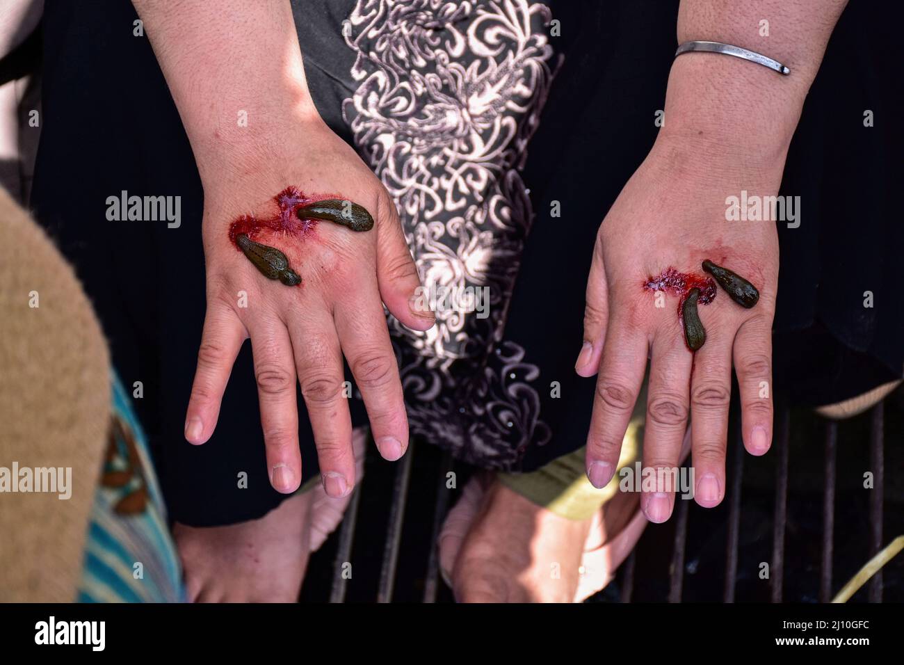 A patient receives leech therapy every year traditional health workers