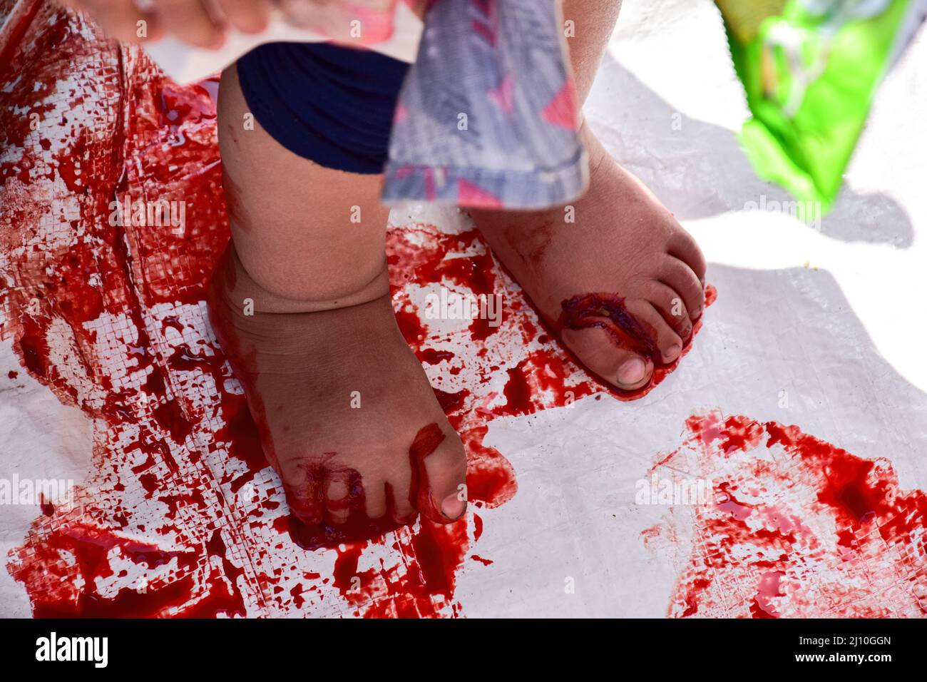 A young patient bleeds after receiving leech therapy on her feet. Every year traditional health workers in Kashmir use leeches to treat people for small, itchy, painful lumps that develop on the skin called chilblains, acquired during the winter on Nowruz (the Iranian New Year), which marks the first day of spring and the beginning of the year in the Persian calendar. (Photo by Saqib Majeed / SOPA Images/Sipa USA) Stock Photo