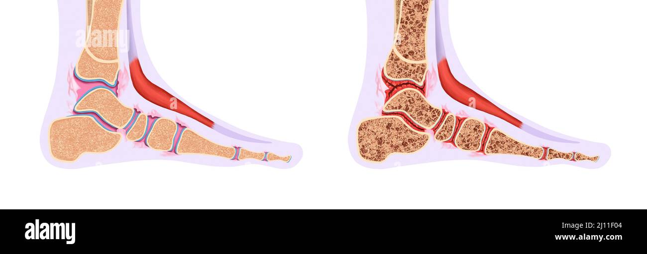 Realistic Illustration of Healthy Ankles and Ankle Diseases Stock Photo