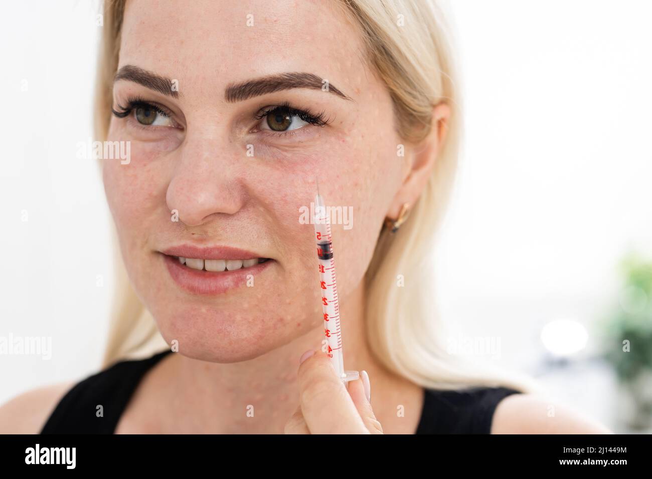 Mesotherapy in the neck and chestneckline. Traces of hyaluronic acid