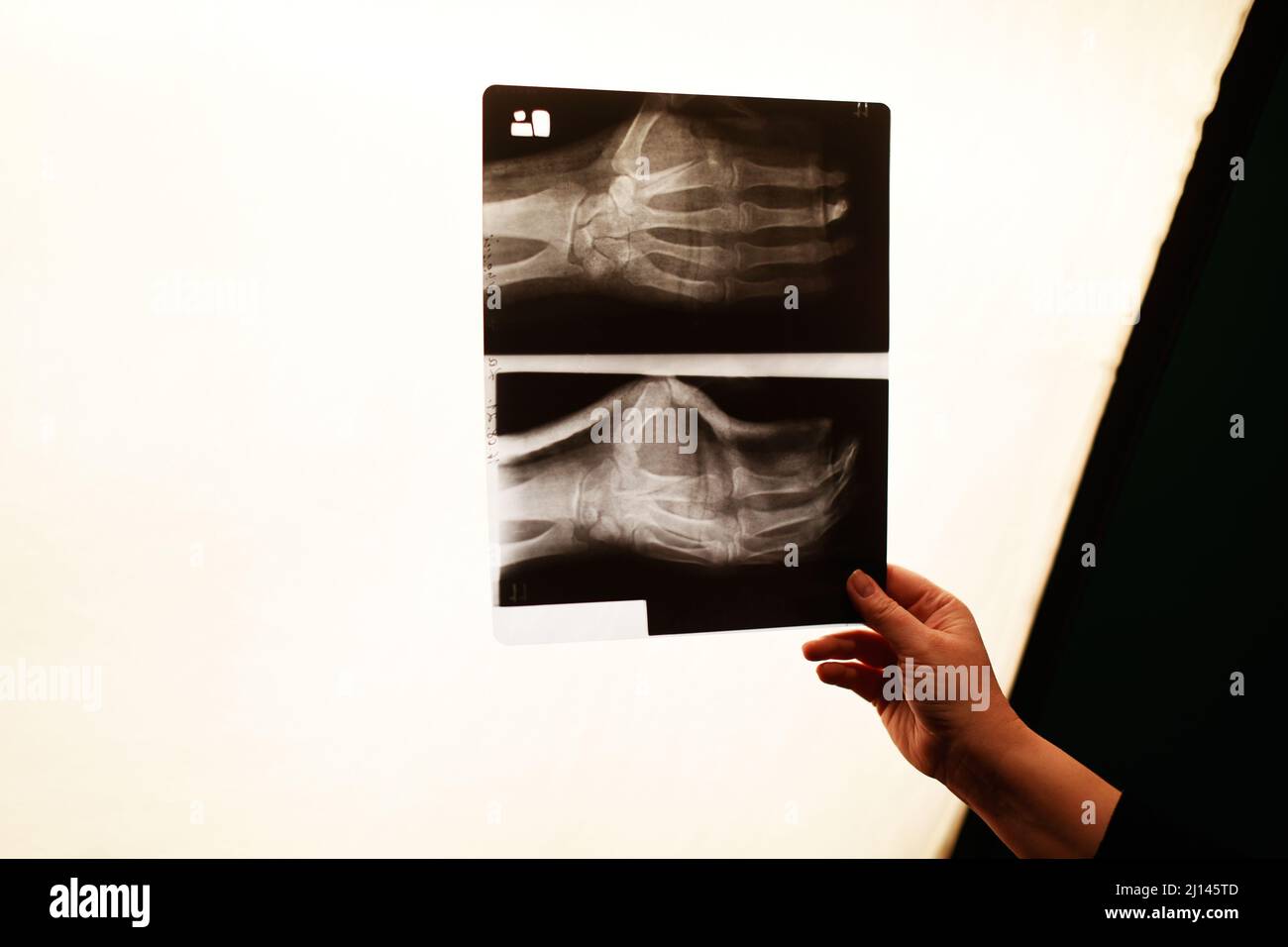 The nurse's hand is holding a x-ray photo of the arm. Arm fracture, medicine. Stock Photo