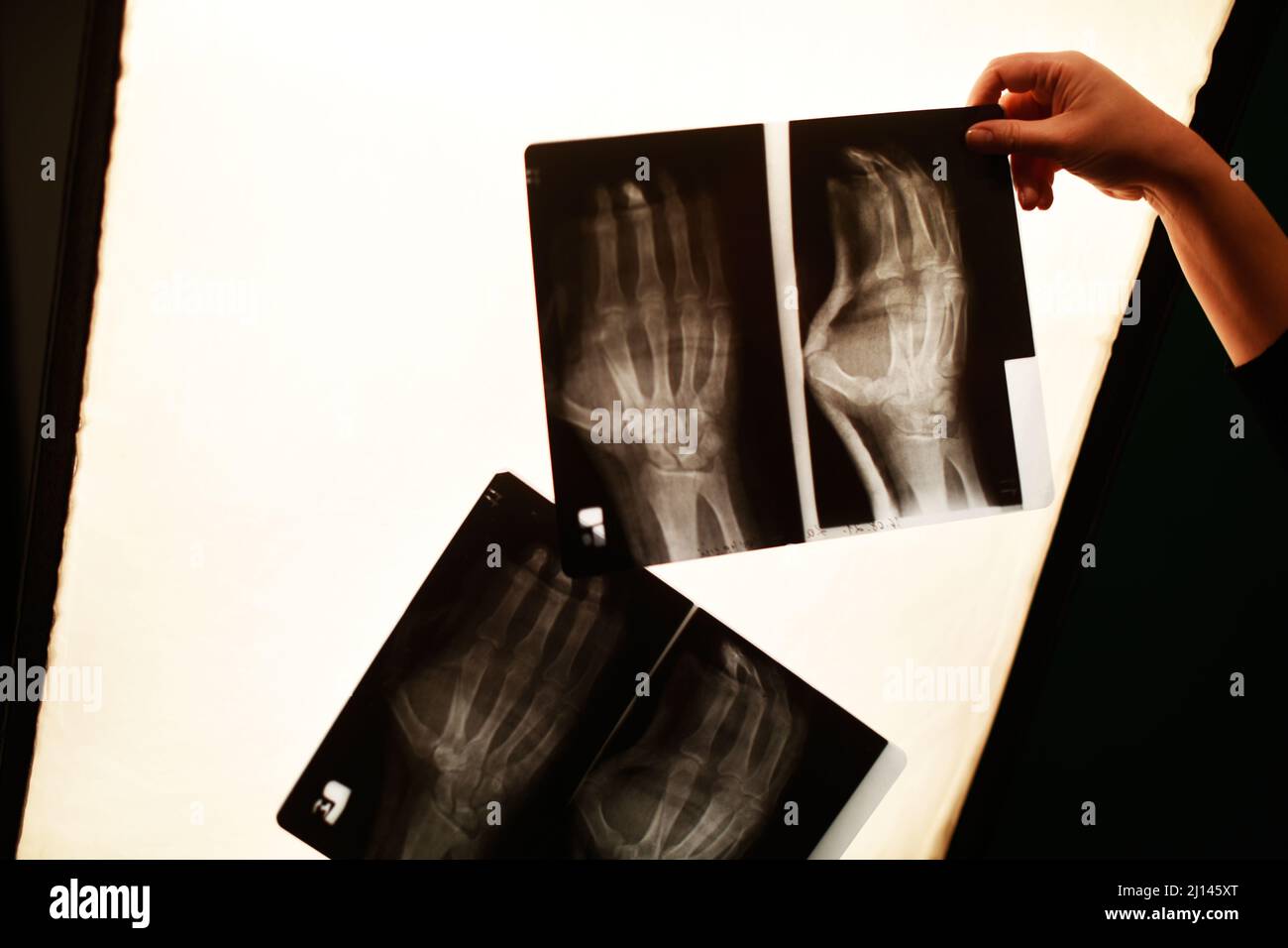 The nurse's hand is holding a x-ray photo of the arm. Arm fracture, medicine. Stock Photo
