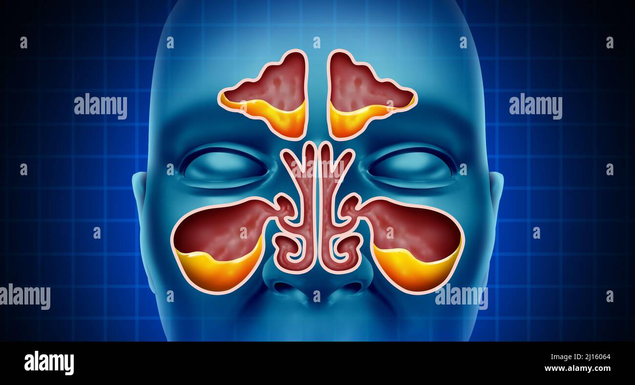 Sinus Infection and Sinusitis illness as a nasal cavity blockage disease with a congested nose full of mucus or pus. Stock Photo