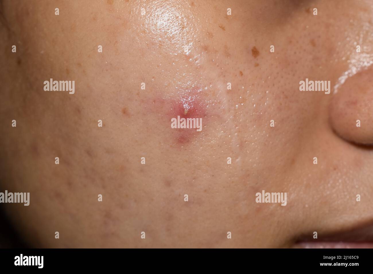 Single cystic acne vulgaris on oily face of Southeast Asian young woman. Stock Photo