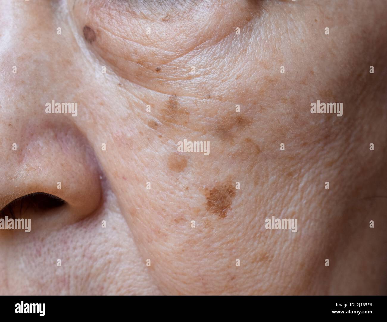 Small brown patches called age spots on face of Asian elder woman. They are also called liver spots, senile lentigo, or sun spots. Closeup view. Stock Photo