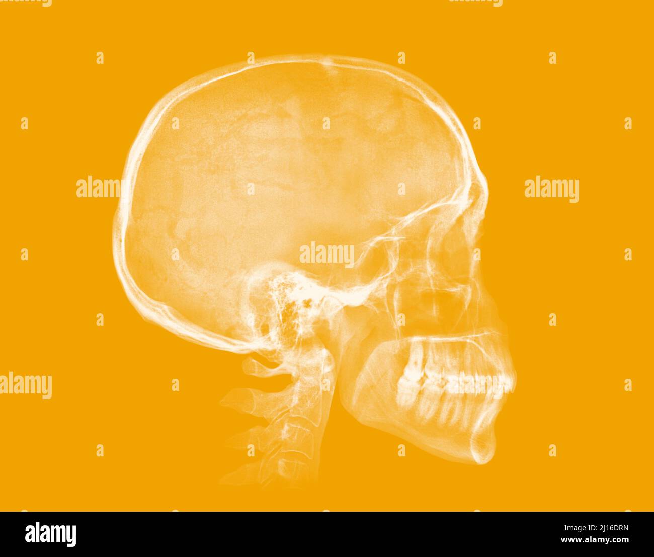 Human skull. X-ray image isolated on yellow background Stock Photo
