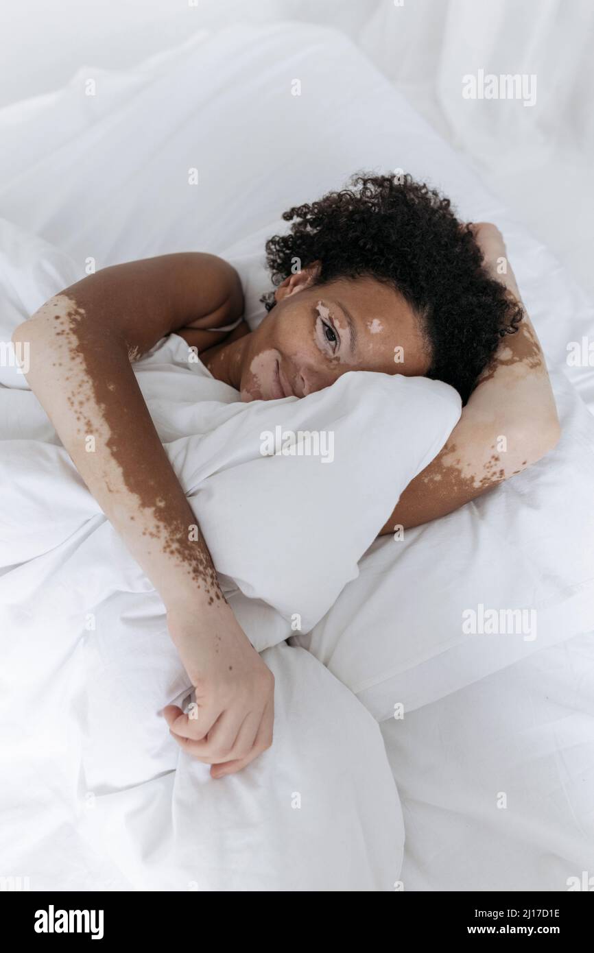 Woman with vitiligo holding pillow between legs on bed in front of white  wall at home