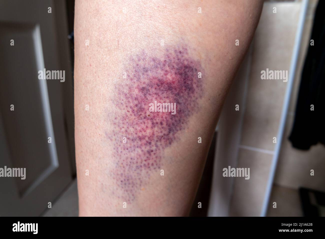 Terrible bruise on the upper leg of a woman. Stock Photo