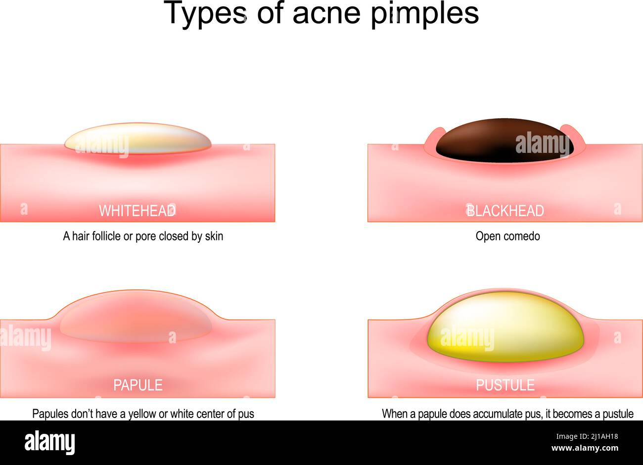 Types of acne pimples. When a papule does accumulate pus, it becomes a pustule. Papules don’t have a yellow or white center of pus Stock Vector