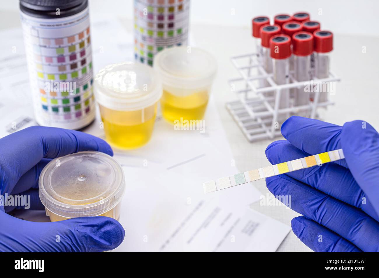 urinalysis with reagent strips to analyze Leukocytes, Urobilinogen
